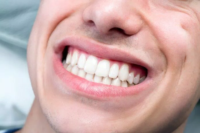 Nghiến mạnh làm cho răng phải chịu lực rất lớn (Ảnh: Internet).