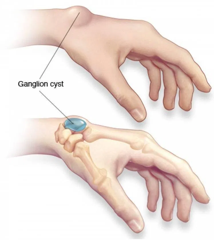 U nang hạch ở mặt sau cổ tay (Ảnh: Internet). U nang hạch ở mặt sau cổ tay (Ảnh: Internet).