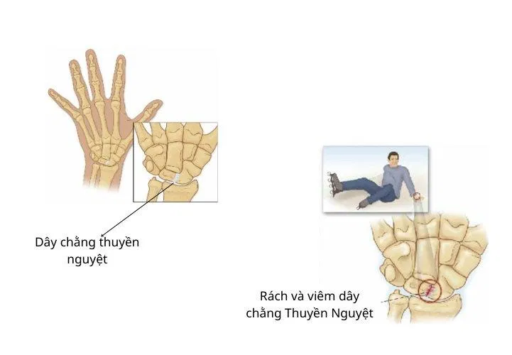 Dây chằng giữa xương thuyền và xương nguyệt ở cổ tay (Ảnh: Internet). Dây chằng giữa xương thuyền và xương nguyệt ở cổ tay (Ảnh: Internet).