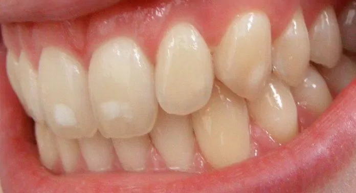 Răng bị đốm trắng do nhiễm fluor (Ảnh: Internet).
