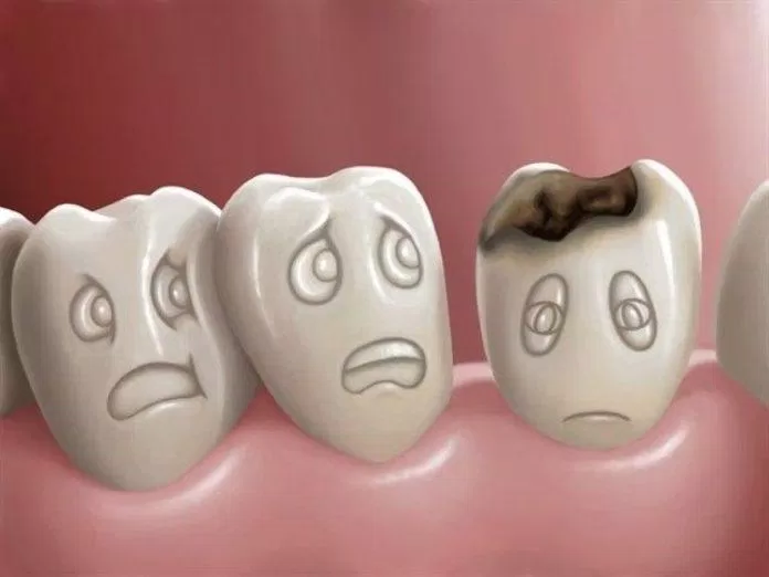 Sâu răng là vấn đề sức khỏe rất phổ biến và gây nhiều tác hại (Ảnh: Internet).