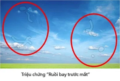Những đốm mờ còn được gọi là "ruồi bay" (Ảnh: Internet). Những đốm mờ còn được gọi là "ruồi bay" (Ảnh: Internet).