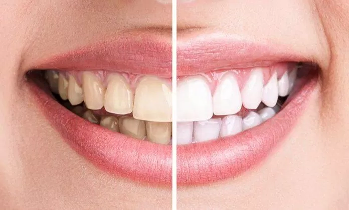 Màu răng không thể hiện sức khỏe chính xác đâu (Ảnh: Internet).