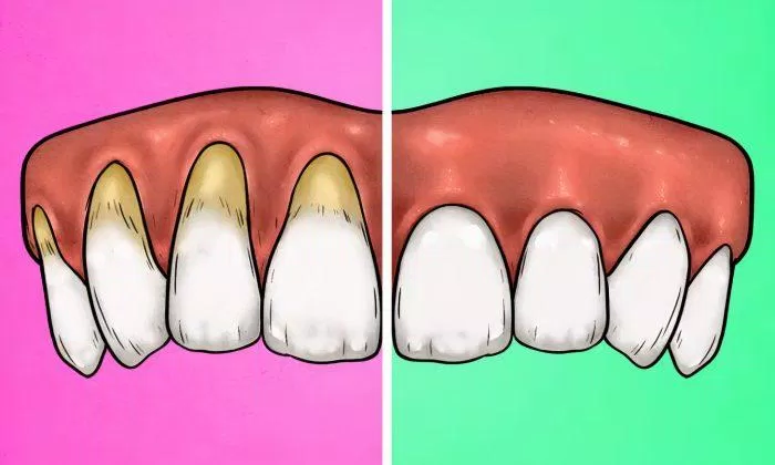 Tụt lợi là một trong những dấu hiệu cho thấy bạn đang đánh răng quá mạnh đấy (Ảnh: Internet).