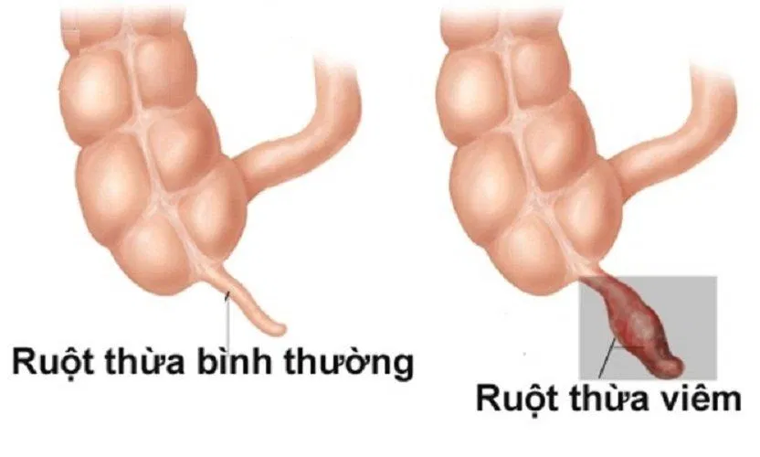 So sánh ruột thừa bình thường và khi bị viêm (Ảnh: Internet).