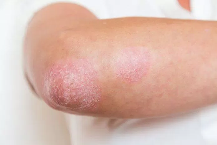 Rất nhiều người vẫn tin rằng bệnh vảy nến có thể lây giống như bệnh ghẻ (Ảnh: Internet). Rất nhiều người vẫn tin rằng bệnh vảy nến có thể lây giống như bệnh ghẻ (Ảnh: Internet).