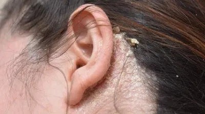 Có phải vảy nến chỉ giống như khô da bình thường? (Ảnh: Internet). Có phải vảy nến chỉ giống như khô da bình thường? (Ảnh: Internet).