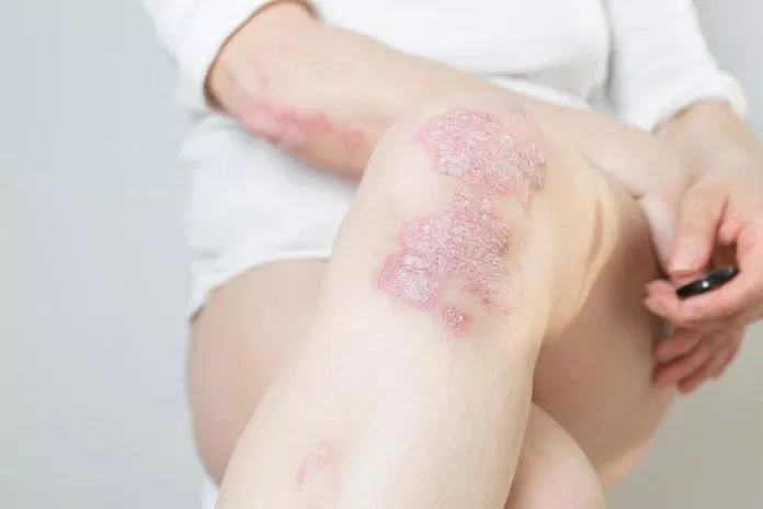Bệnh vảy nến làm cho da bị dày và tróc ra từng mảng (Ảnh: Internet). Bệnh vảy nến làm cho da bị dày và tróc ra từng mảng (Ảnh: Internet).