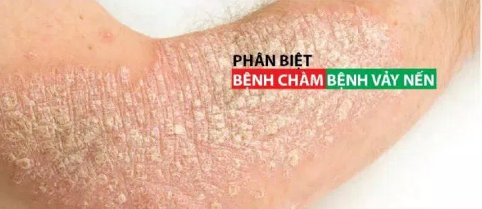 Chàm và vảy nến có nhiều điểm khác nhau (Ảnh: Internet). Chàm và vảy nến có nhiều điểm khác nhau (Ảnh: Internet).