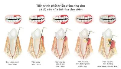Viêm nướu tiến triển nặng sẽ dẫn tới viêm nha chu (Ảnh: Internet). Viêm nướu tiến triển nặng sẽ dẫn tới viêm nha chu (Ảnh: Internet).