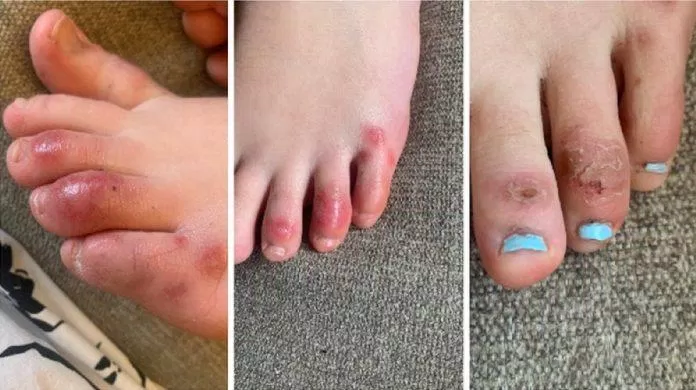 Biểu hiện "ngón chân COVID": ngón chân bị sưng đỏ và đau (Ảnh: Internet).