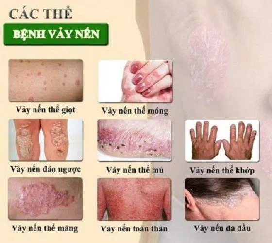 Bệnh vảy nến có nhiều thể khác nhau (Ảnh: Internet). Bệnh vảy nến có nhiều thể khác nhau (Ảnh: Internet).