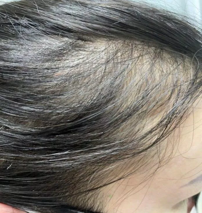 Tóc rụng nhiều có thể do bệnh lý gây nên (Nguồn: Internet)