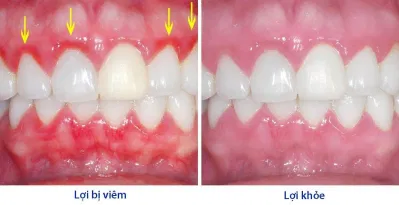 Sự khác biệt dễ nhận thấy khi nướu bị viêm (Ảnh: Internet). Sự khác biệt dễ nhận thấy khi nướu bị viêm (Ảnh: Internet).