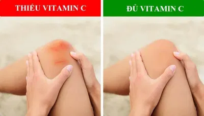 Vitamin C có vai trò quan trọng đối với các vết thương trên cơ thể (Ảnh: Internet). Vitamin C có vai trò quan trọng đối với các vết thương trên cơ thể (Ảnh: Internet).
