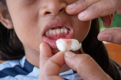 Dùng gạc là cách đơn giản và nhanh chóng để cầm máu (Ảnh: Internet). Dùng gạc là cách đơn giản và nhanh chóng để cầm máu (Ảnh: Internet).