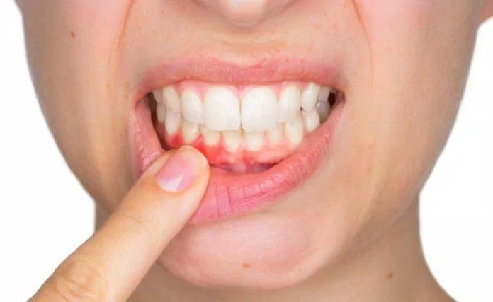Chảy máu chân răng là triệu chứng rất thường gặp ở răng miệng (Ảnh: Internet).