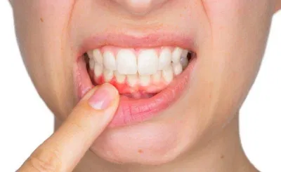 Chảy máu chân răng là triệu chứng rất thường gặp ở răng miệng (Ảnh: Internet). Chảy máu chân răng là triệu chứng rất thường gặp ở răng miệng (Ảnh: Internet).