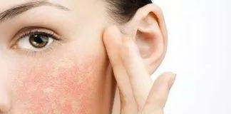 Da kích ứng, cháy nắng thường xuất hiện mẩn đỏ, ngứa rát (Ảnh: Internet).