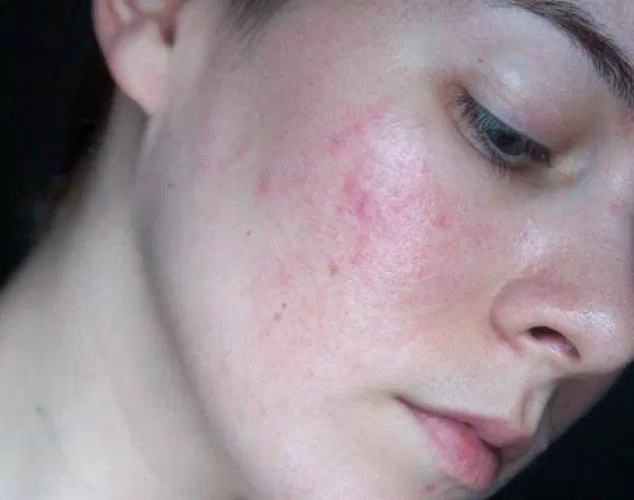 La peau sensible est très facilement irritée et sujette à l'acné (Photo : Internet).