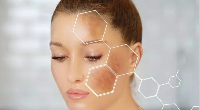 Nám da là tình trạng xuất hiện những đốm nâu trên mặt ( Nguồn: Internet)