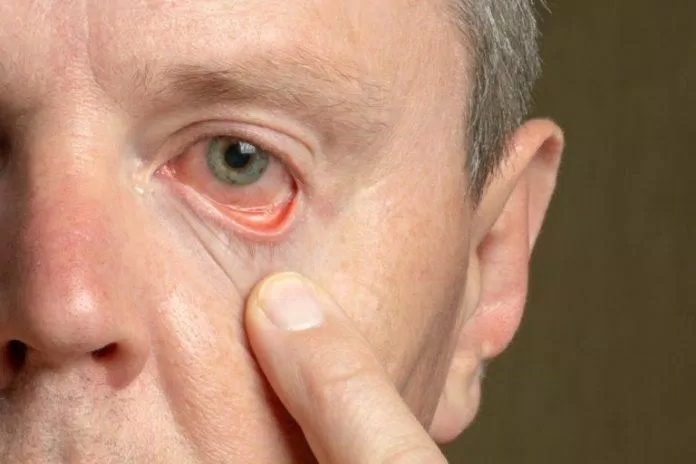 Bất thường ở mắt cũng có thể là dấu hiệu của COVID-19 (Ảnh: Internet).