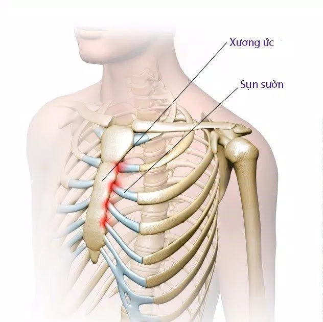 Sụn sườn là phần sụn nối giữa xương sườn với xương ức (Ảnh: Internet). Sụn sườn là phần sụn nối giữa xương sườn với xương ức (Ảnh: Internet).