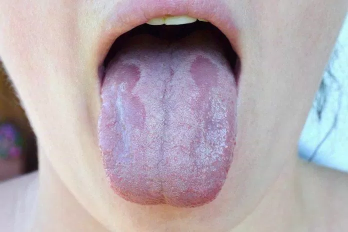 Bệnh tưa miệng thường chỉ gặp ở những người bị suy giảm miễn dịch (Ảnh: Internet).