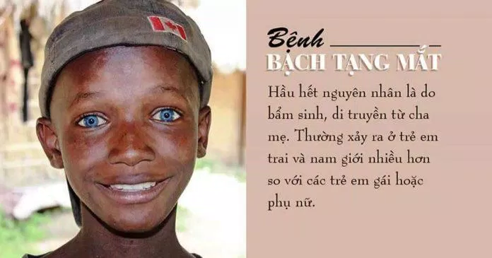 Những người bị bạch tạng ở mắt thường có đôi mắt màu xanh lam (Ảnh: Internet). Những người bị bạch tạng ở mắt thường có đôi mắt màu xanh lam (Ảnh: Internet).