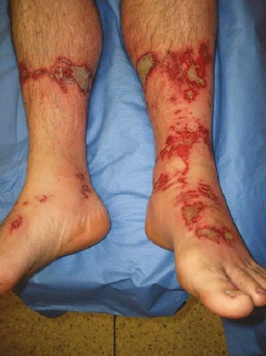 Vết bỏng do xi măng ở chân (ảnh: Internet).
