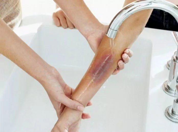 Rửa vết bỏng bằng nước sạch (ảnh: Internet).