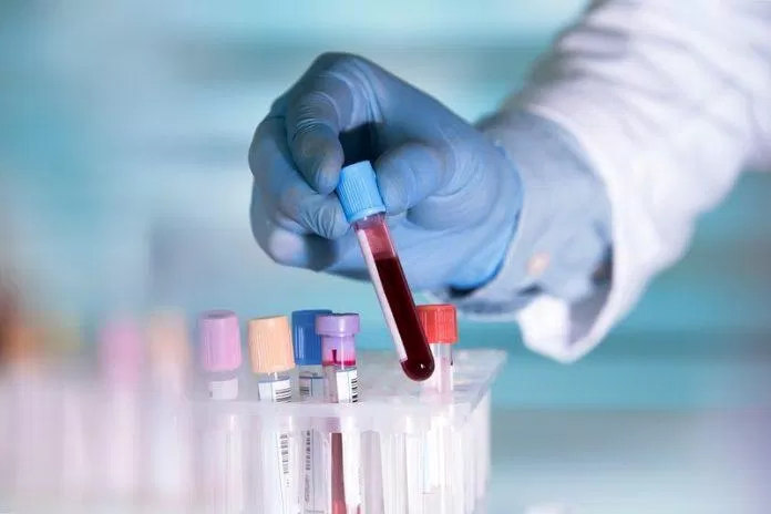 Một mẫu máu có thể làm được rất nhiều xét nghiệm khác nhau (Ảnh: Internet).