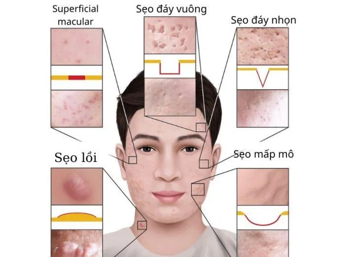 Mỗi loại sẹo đều có cách chữa trị khác nhau và hiệu quả cũng khác nhau (Ảnh: Internet)