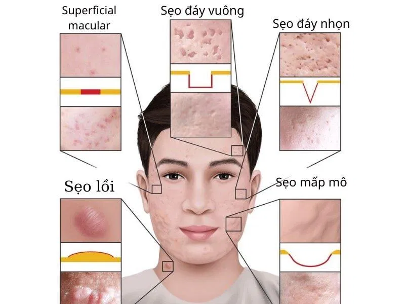 Mỗi loại sẹo đều có cách chữa trị khác nhau và hiệu quả cũng khác nhau (Ảnh: Internet)