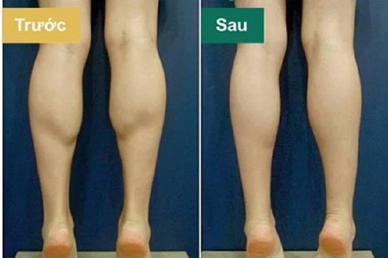 Kiễng chân giúp giảm mỡ bắp chân (Ảnh: Internet). Kiễng chân giúp giảm mỡ bắp chân (Ảnh: Internet).