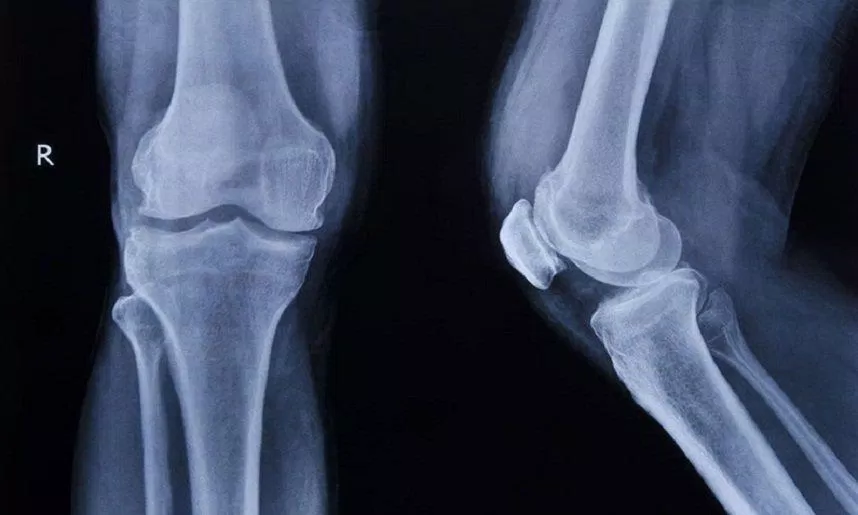 Chẩn đoán hình ảnh phát hiện viêm khớp (Ảnh: Internet) Chẩn đoán hình ảnh phát hiện viêm khớp (Ảnh: Internet)
