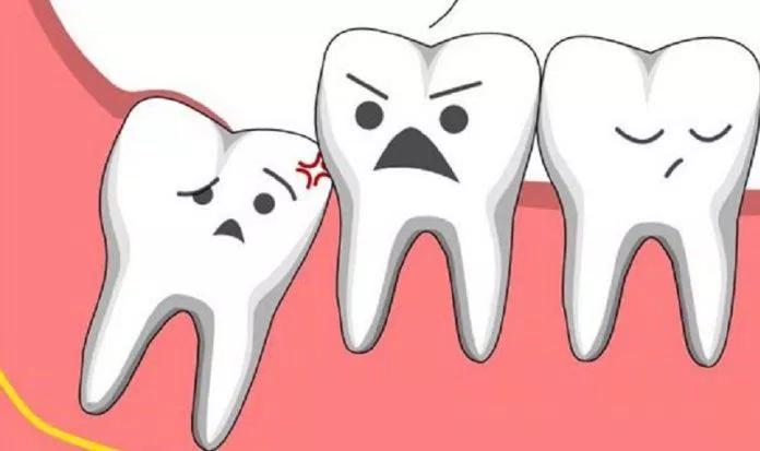 Những chiếc răng khôn mọc lệch gây nhiều phiền toái cho chúng ta (Ảnh: Internet). Những chiếc răng khôn mọc lệch gây nhiều phiền toái cho chúng ta (Ảnh: Internet).