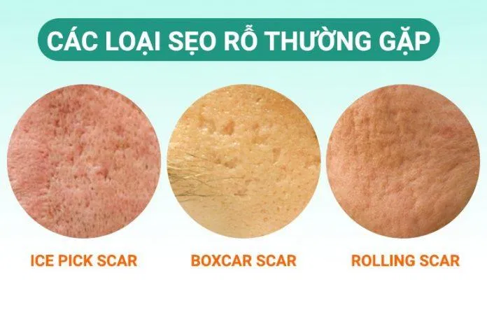 Phân loại sẹo rỗ (Ảnh: Internet)