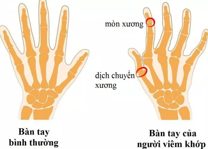 Sự khác biệt giữa tay người thường và người bị viêm khớp (Ảnh: Internet). Sự khác biệt giữa tay người thường và người bị viêm khớp (Ảnh: Internet).