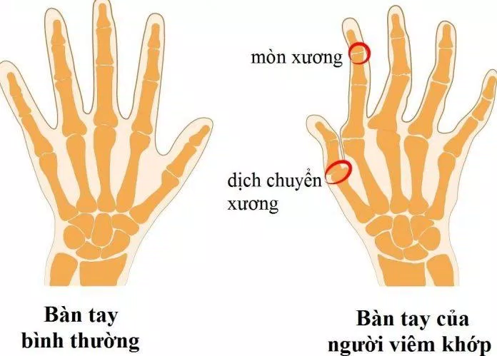 Sự khác biệt giữa bàn tay bình thường và người bị viêm khớp (Ảnh: Internet).