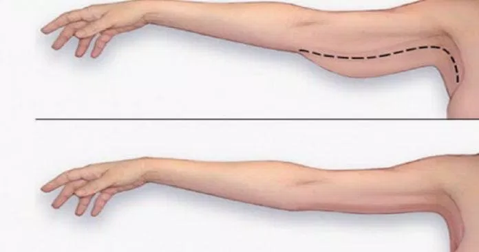 Mỡ thừa khiến cánh tay của bạn kém săn sắc và ảnh hưởng đến nhan sắc tổng thể rất nhiều (Ảnh: Internet).