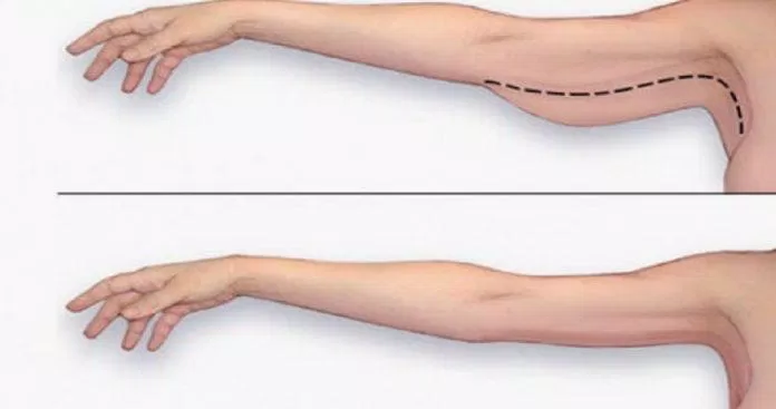 Mỡ thừa khiến cánh tay của bạn kém săn sắc và ảnh hưởng đến nhan sắc tổng thể rất nhiều (Ảnh: Internet). Mỡ thừa khiến cánh tay của bạn kém săn sắc và ảnh hưởng đến nhan sắc tổng thể rất nhiều (Ảnh: Internet).