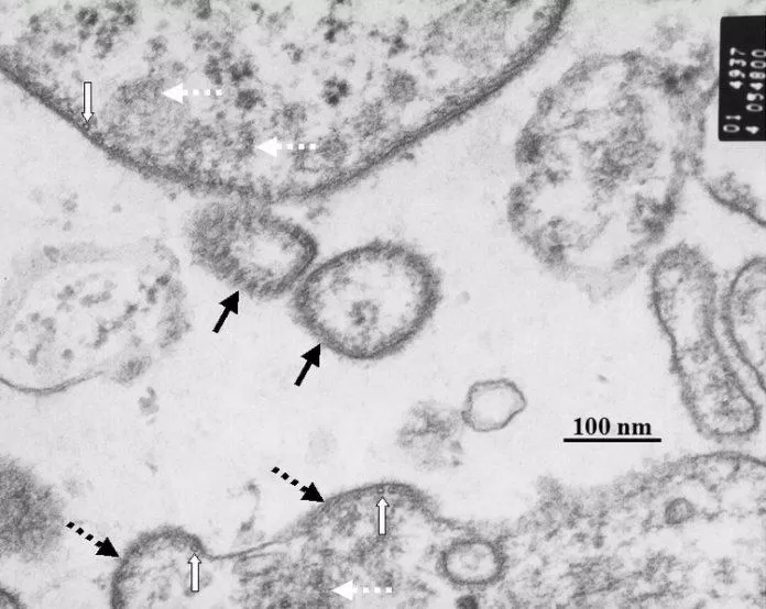 Virus Nipah nhìn dưới kính hiển vi (mũi tên màu đen liền nét) (Ảnh: Internet). Virus Nipah nhìn dưới kính hiển vi (mũi tên màu đen liền nét) (Ảnh: Internet).