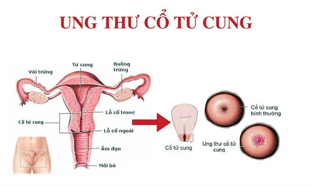 Bệnh ung thư cổ tử cung (Nguồn: Internet). Bệnh ung thư cổ tử cung (Nguồn: Internet).