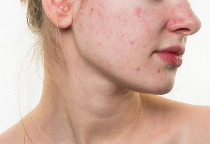 Da mụn (Ảnh: Internet).