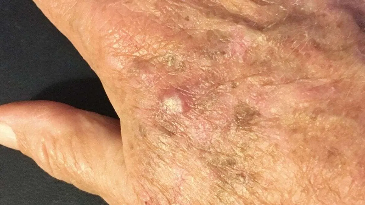 Dày sừng hoạt tính là một rối loạn của da gây ra các mảng da sần sùi, có vảy (Ảnh: Internet). Dày sừng hoạt tính là một rối loạn của da gây ra các mảng da sần sùi, có vảy (Ảnh: Internet).