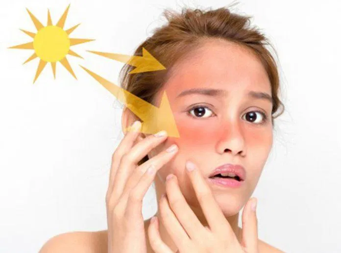 Da dễ bị kích ứng, cháy nắng khi tiếp xúc với ánh nắng mặt trời mà không sử dụng kem chống nắng (Ảnh: Internet).