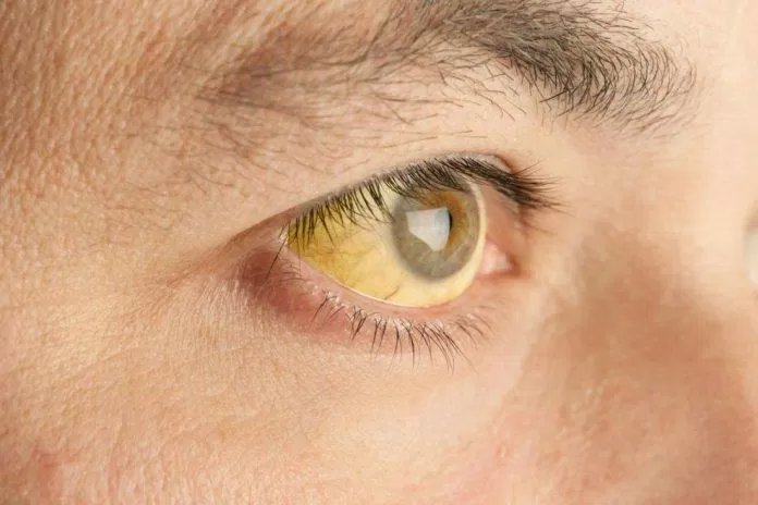 Vàng da vàng mắt là dấu hiệu phổ biến của bệnh gan (Ảnh: Internet).