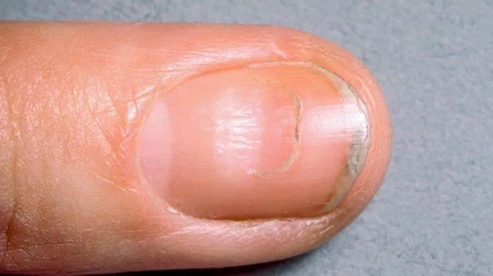 Đường Beau trên móng là bệnh gì? (Ảnh: Internet). Đường Beau trên móng là bệnh gì? (Ảnh: Internet).