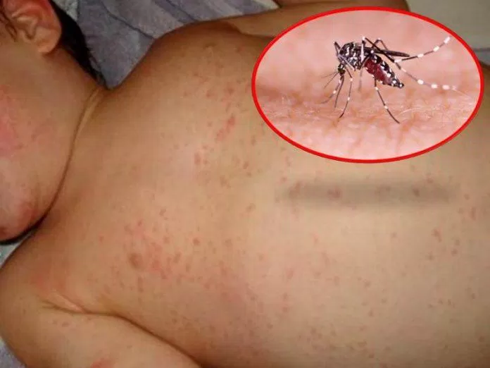 Phát ban dạng chấm đỏ là triệu chứng thường gặp khi bị sốt xuất huyết (Ảnh: Internet).